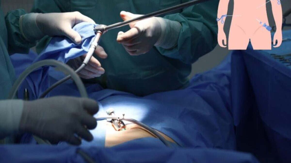 Laparoscopic Surgery